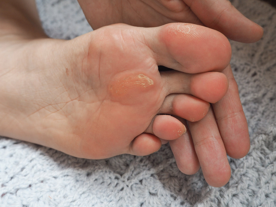Corn & Callus Home Treatment Guide: 14 Podiatrist-Approved Solutions