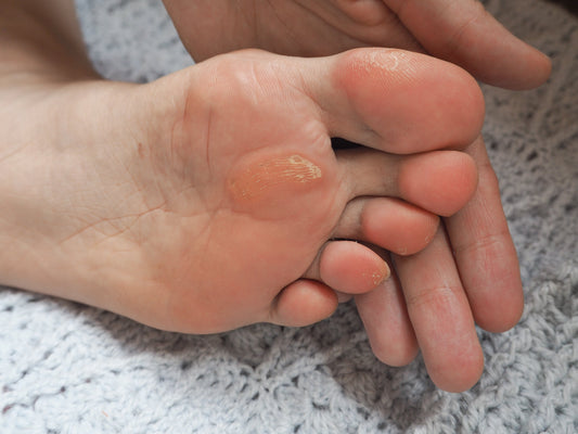 Corn & Callus Home Treatment Guide: 14 Podiatrist-Approved Solutions
