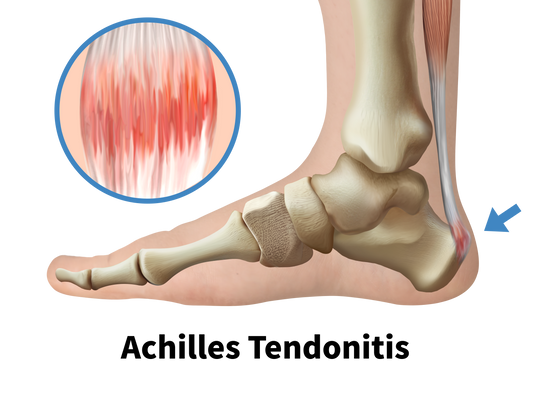 Achilles Tendonitis Relief Tools: Recovery Essentials