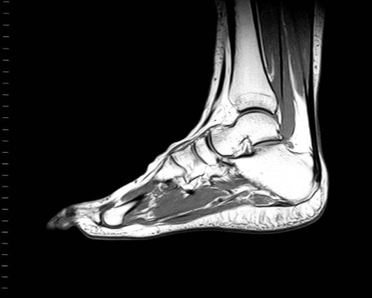 Plantar Fasciitis vs Plantar Fasciosis: The Critical Difference Every Patient Must Know
