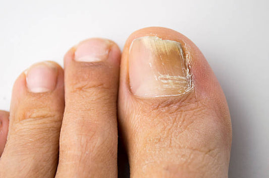 Toenail Fungus Remedies That Work: Evidence & OTC Solutions