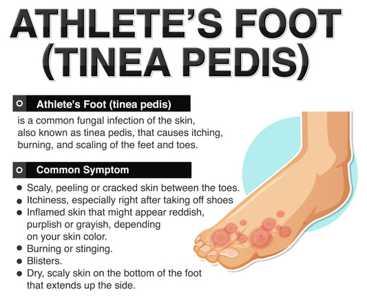 What You Need to Know About Athlete’s Foot and Foot Fungus
