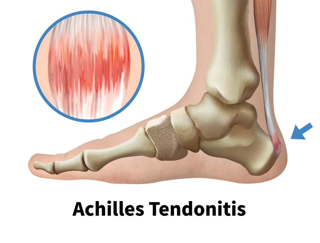 Achilles Tendonitis Relief Tools: Recovery Essentials