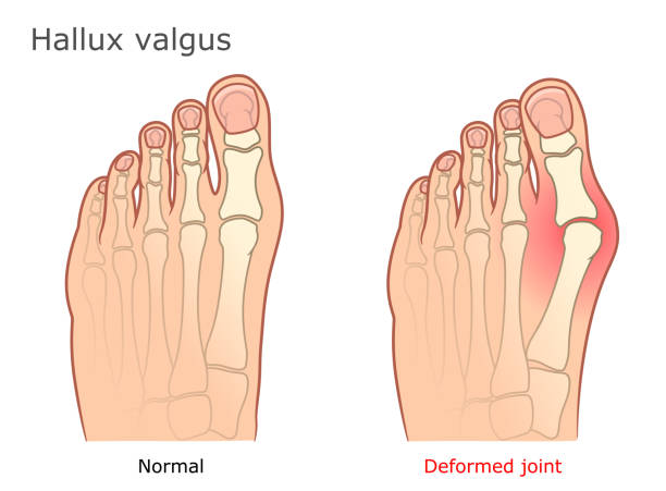 Bunions 101: Symptoms, Causes, and Non-Surgical Fixes
